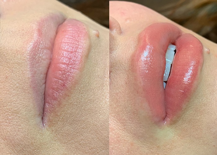 lip blush treatment in delhi